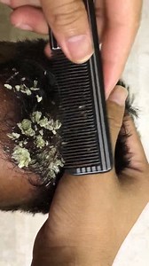 Giant Dandruff Sheet Removal M232 — Shocking Close-Up #ticks #Dandruff #dandrufftreatment #fblifestyle #fypシ | Humayun Afridi 0.2