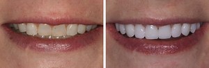 Cosmetic Dentist Sugar Land TX - Porcelain Crowns Houston TX