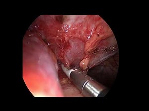 subxiphoid uniportal VATS extended thymectomy