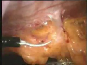 Laparoscopic Repair Of Incisional Hernia