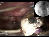 Endoscopic Treatment of Consequences of Acute Necortizing Pancreatitis • Video • MEDtube.net