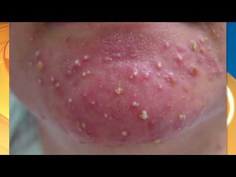 Dr. Pimple Popper on how to identify your acne and the ways to treat it