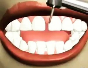 Closing diastema with tooth bonding. #harvandental | Harvan Dental Clinic