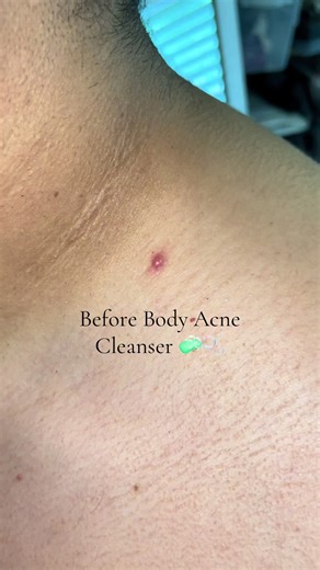 #body #cleanser #acne #pimple #skincareroutine