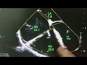 Ebstein Anomaly Pre and Post Surgical Repair