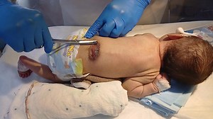 Neonatal Myelomeningocele Care: Essential Pre-Surgical Dressing and Management #baby #babycare #care #babycare #nicucare This guide outlines the critical, immediate postnatal dressing procedure and management for a newborn with an open myelomeningocele defect. The primary goals of this care are to protect the exposed neural tissue from trauma, prevent infection, and maintain moisture and warmth until definitive surgical closure can be performed, ideally within 24 to 48 hours. Key steps include s