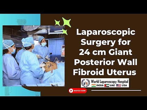 Laparoscopic Surgery for 24 cm Giant Posterior Wall Fibroid Uterus | World Laparoscopy Hospital
