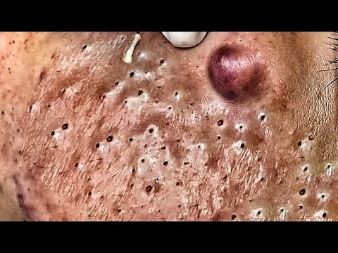 2020 Pimple Popping Year in Review! Biggest Pimples,