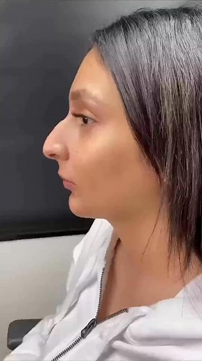 This young woman looks completely unrecognizable after getting a nose job... Check in Comments 👇👇👇 #nosejob | Lyle J. Horn