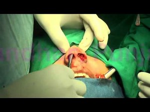 Nose cosmetic surgery - Hump Reduction Rhinoplasty.