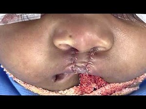 Right sided complete and left incomplete cleft lip repair done with combination technique - Dr Sunil