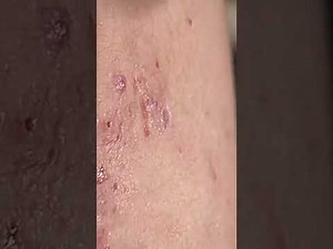 Blackheads with Din Spa ♥️ 😘