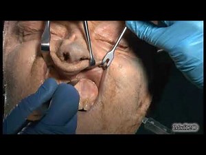 midfacial degloving approach in cadaver