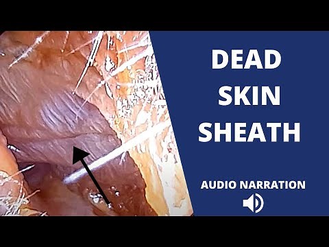 Well preserved dead skin sheath in ear canal peeled away with suction