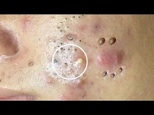 Best Blackhead Removal Ever 55min - Facial Acne Treatment - Gà Spa