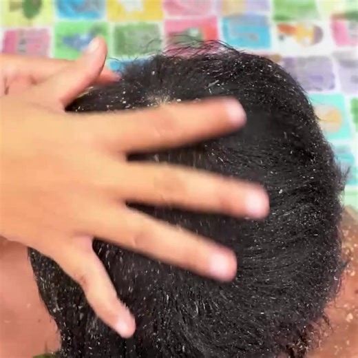 Dandruff Big Flakes Satisfying Removal Maggot Worms On Hole #1701 Part 15 | Help remove ticks