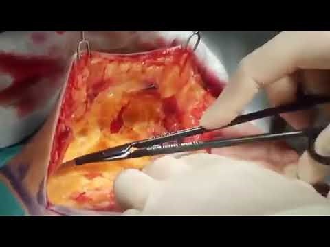 Medical operations Mastectomy Full Operation