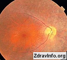 Retinóza oka - jaká je tato patologie a jak se ji zbavit? 👃👃 Portál Sinus A Další. - 2025