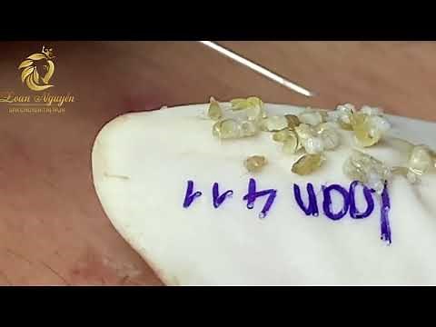 Blackheads and whiteheads extraction (411) | Loan Nguyen