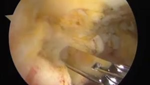 Arthroscopic Osteochondroma Knee Resection