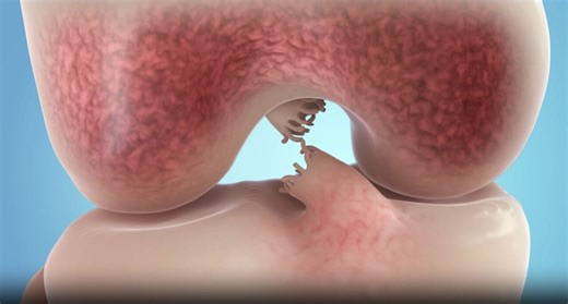 New ACL repair surgery heals ligament