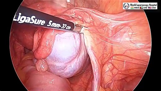 Transvaginal Extraction of Ovary by Laparoscopic Salpingo-Oophorectomy for Optimal Patient Care
