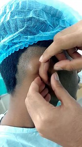 Post auricular dermoid cyst | Dr. Khaled Hasan Milu