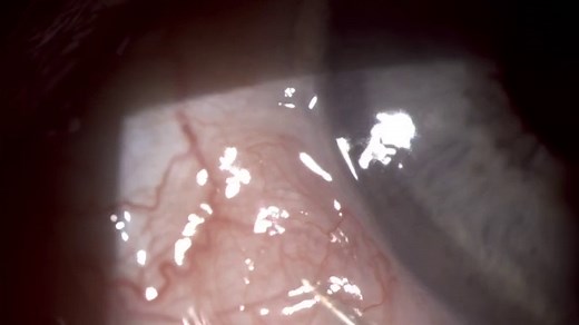 How to drain a conjunctival cyst at the slit lamp