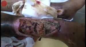 The wound leg is filled with caterpillars