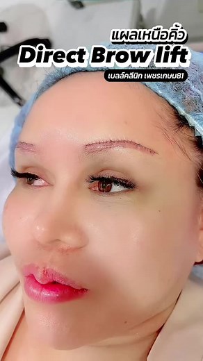 Direct Brow lift.✨✨👁️ ยกคิ้ว แผลเหนือคิ้ว | เบลล์ คลินิก ศัลยกรรมความงาม