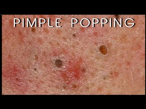 Popping pimples and blackheads - 1
