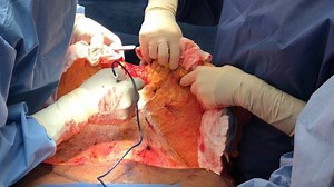 It’s Medical Monday! Don’t forget about the belly button! Check out the full video on our YouTube channel Lexington Plastic Surgeons “Tummy Tuck with Dr. Jones” Don’t forget to click SUBSCRIBE!!! - - - #lexingtonplasticsurgeons #surgery #liposuction #lipo #tummytuck #tummytuckjourney #plasticsurgery #nycplasticsurgery #nyc #newyork #newyorkcity #miami #atlanta #houston #newjersey #beauty #fountainofyouth #transformation #makeover #selfcare | Lexington Plastic Surgeons