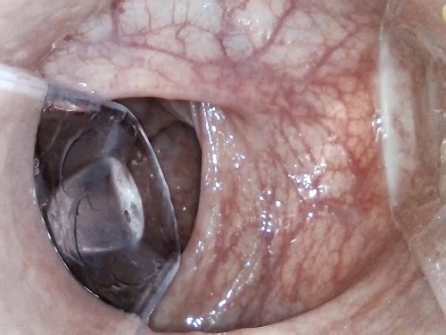 Yaha_ferh Latina Anal Insertion, Speculum, Endoscope, Venous Colon – Premium user Request