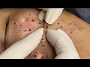 Remove a lot of Blackheads on the Cheeks