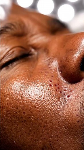 Super Close-Up Pore Cleaning You Can’t Stop Watching!”