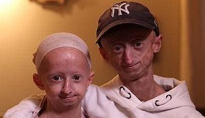 Belgium Brother, Sister Battle Incredibly Rare 'Benjamin Button Disease' | Al Bawaba