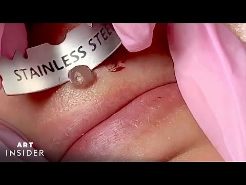 How Moles Are Shaved Off