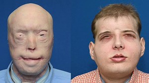 The man with a new face after 'world's most extensive' transplant