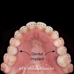 Non surgical and non extraction treatment of a severe skeletal class III malocclusion 醴 . upper arch mechanotherapy:Dental expansion and reopening extraction spaces . by: @dr.setareh.khosravi | Dentistry blog | Facebook