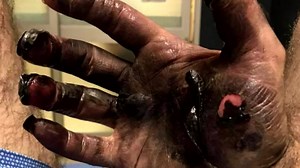 Fort Worth man suffers 3rd degree burns after e-cigarette explodes in his pocket