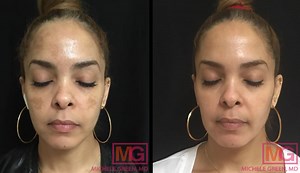 Melasma Treatment, Skin Care & Dermatology Treatments NYC