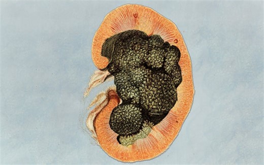 一位运动员在20分钟内做了500个深蹲，这是他的肾脏发生的变化