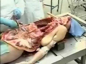 procedure of autopsy