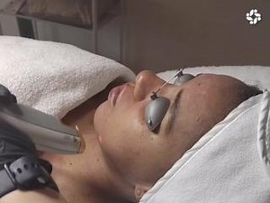 Laser Genesis, a versatile treatment suitable for all Fitzpatrick skin types, offers a multitude of benefits. It gently heats the deeper layers of the skin, stimulating collagen production, improving texture, reducing fine lines, and minimising pore size. This non-invasive procedure also addresses redness and diffuses uneven pigmentation, promoting a rejuvenated complexion. ‌ The beauty of Laser Genesis lies in its ability to provide noticeable results with virtually no downtime. Experience a mo