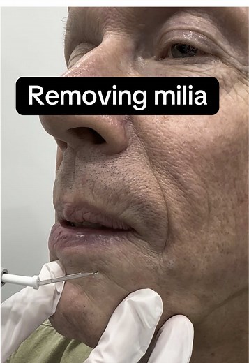 Milia Removal: Cautery and Comedone Extraction Techniques