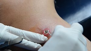 Infirmière abcès ouvert par aiguille.