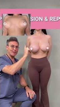 NATURAL BIG BREAST IMPLANT REVISION (BREAST AUGMENTATION)