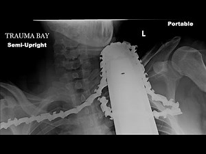 Horrific chainsaw accident: Man gets blade stuck in neck and survives