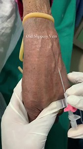 How to Identify and Handle an Old Slippery Vein (Student Nurse Guide)