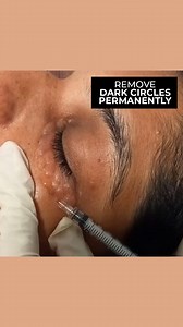 7.9K views · 30 reactions | Erase the shadows of fatigue. Our expert dark circle removal service revitalizes tired eyes, revealing a vibrant and refreshed appearance. Book a consultation with us: 0117 499 299 Rediscover your natural radiance. . . #ChristellSkinClinic #Christell #christellwellness #LuxuryWellness #Skincare #darcircles #darcirclestreatment | Christell Skin Clinic | Facebook